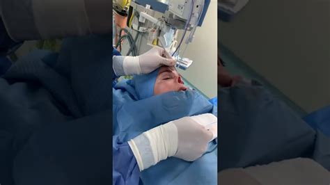 Rinoplastia con injerto de cartílago costal y pabellón auricular 3 3