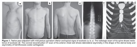 Scielo Brasil The Spine Lateral Bending And The Dynamic Chest