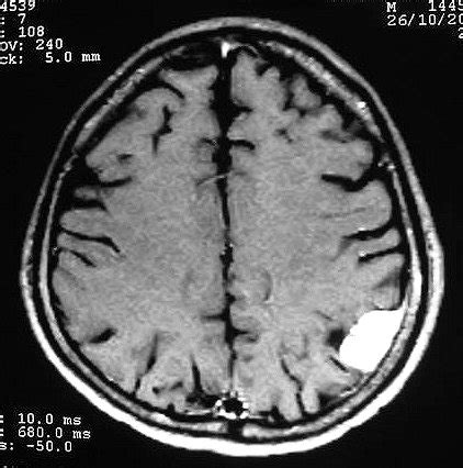 Meningioma O que é sintomas e tratamento Dr Marcelo Acosta