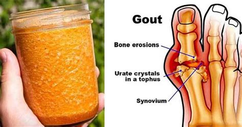 Cure Gout Forever By Using This Natural Treatment