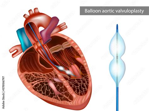 Balloon Aortic Valvuloplasty Or Bav The Balloon Catheter Is Advanced