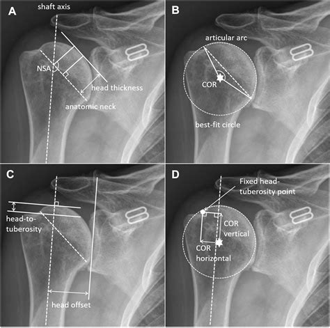 Fixed Vs Variable Angle Humeral Neck Cut In Anatomic Total Shoulder