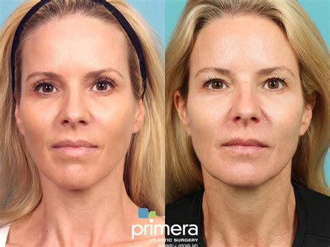 Sculptra Aesthetic For Orlando Winter Park Fl Primera Plastic Surgery