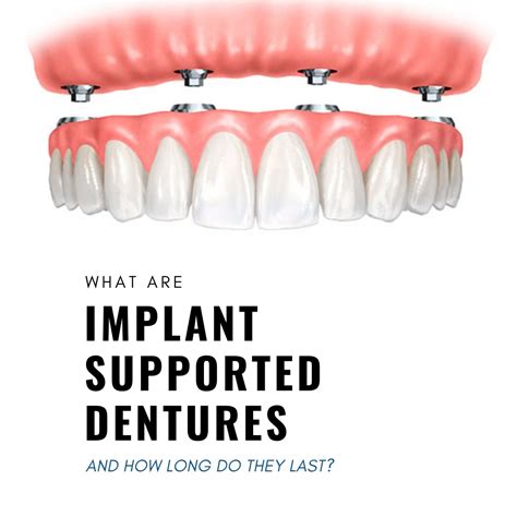 IMPLANT SUPPORTED DENTURES | YYC Denture Clinic