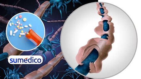 Oms Integra F Rmacos Contra Esclerosis M Ltiple En Su Lista De