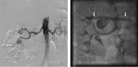 Aortografia Por Subtra O Digital E Arteriografia Renal Final Ap S