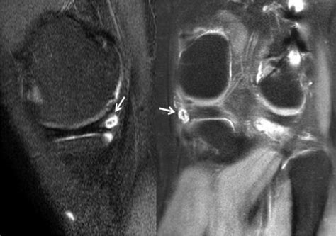 Incidence And Risk Factors For Meniscal Cyst After Meniscal Repair