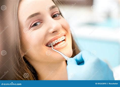 Woman`s Smile with Dental Braces Stock Image - Image of dentistry ...