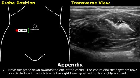 How To Scan Appendix Ultrasound Probe Positioning Transducer Placement Abdominal Usg