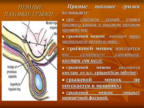 Как отличить косую паховую грыжу от прямую - 90 фото
