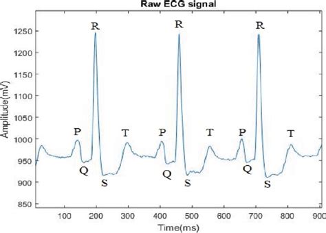 Peaks In A Normal Ecg Signal Download Scientific Diagram