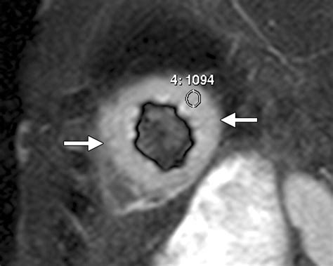 Mr Imaging Of Myocardial Infarction Radiographics