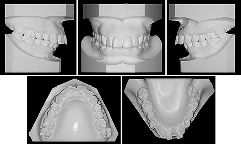 Adult Skeletal Class Ii High Angle Case Treated With A Fully Customized Lingual Bracket