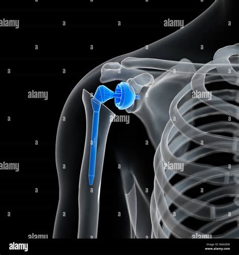 Schultergelenk Implantat D Fotos Und Bildmaterial In Hoher Aufl Sung