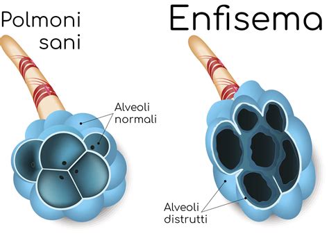 Enfisema Polmonare Sintomi Diagnosi Cura