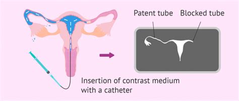 Blocked Fallopian Tubes - Causes, Diagnosis & Treatment