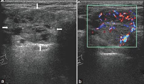 Thyroid Nodule Thyroid Cancer Ultrasound Colors – Warehouse of Ideas