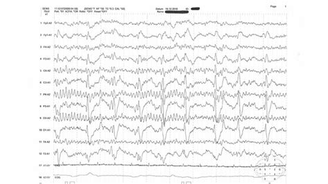 Periodisch Lateralisierte Komplexe Pleds Im Eeg Mt Dialog