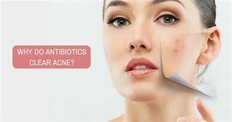 Do Antibiotics Help In Treating Acne