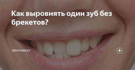 Как выровнять один зуб без брекетов? | DentConsult | Дзен