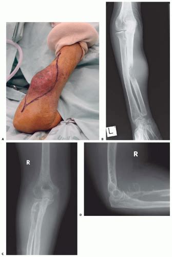 Above Elbow And Below Elbow Amputations Musculoskeletal Key