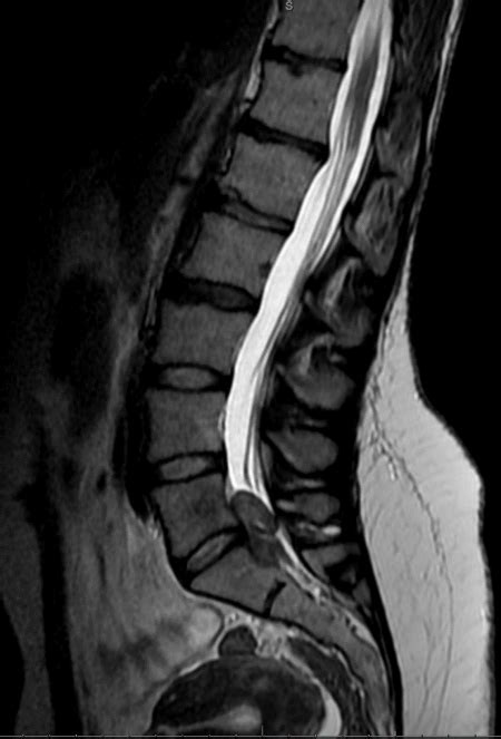 Posterior Approach For Giant Sacral Schwannoma Cns Org