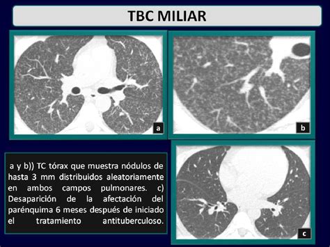 Figure From Manifestaciones Radiol Gicas De La Tuberculosis Pulmonar