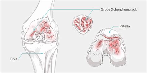 Chondromalacia - The Complete Injury Guide - Vive Health