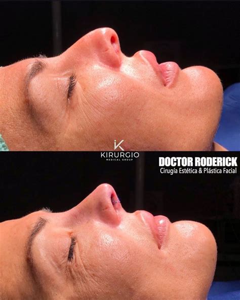 Rinoplastia Barcelona Kirurgio Medical Center