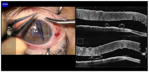 Challenges Of Dmek Technique With Young Corneal Donors Grafts