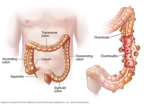 Los Divertículos En El Colon Diverticulosis Y Diverticulitis