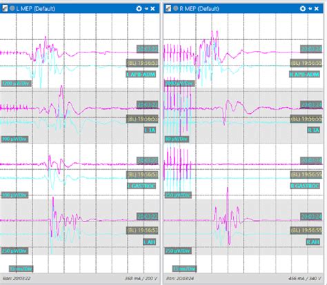 Evoked Potentials Modalities And Anesthetic Effects Openanesthesia