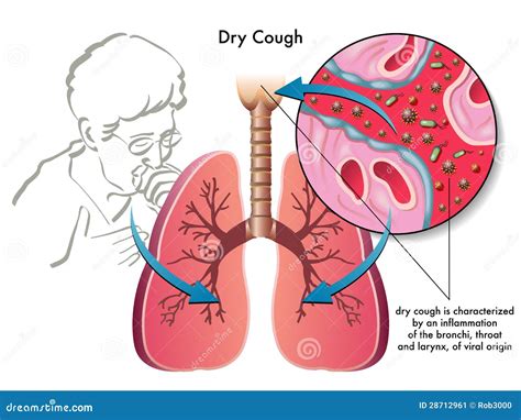 Dry Cough Stock Image - Image: 28712961