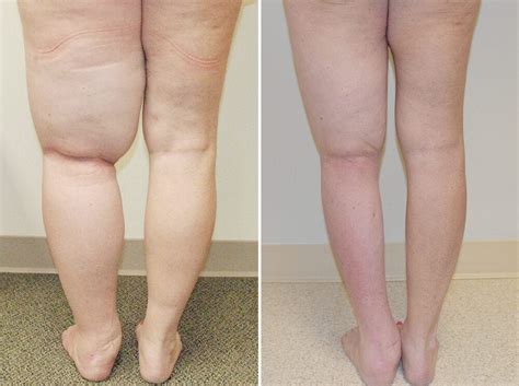 Success Stories Patty Lymphedema Lipedema Center