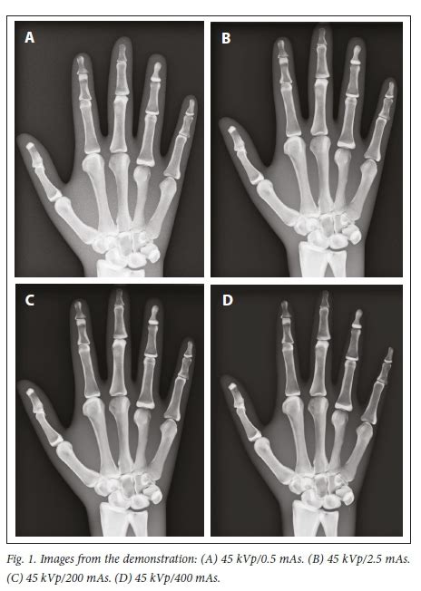 Exposure To X Ray