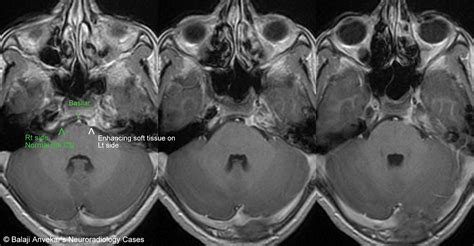 Dr Balaji Anvekar FRCR: 6th CN Palsy in Apical Petrositis MRI