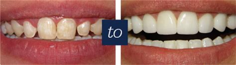 Lumineers Vs Veneers Before After