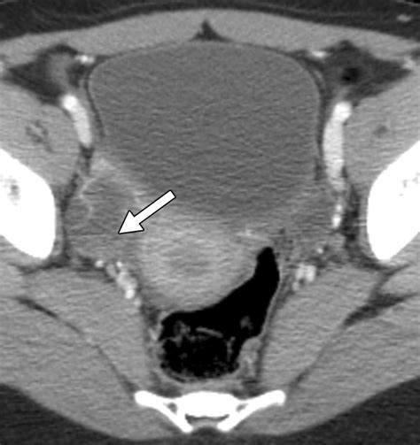 Adnexal Masses In Female Pediatric Patients Ajr