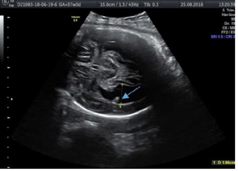 Ultrasound at 35 weeks of gestation demonstrating no signs of... | Download Scientific Diagram