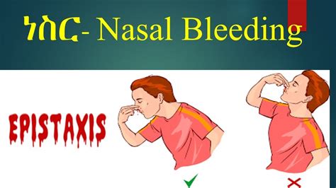 Epistaxis definition causes emergency first aids ነስር ምንነት ተያያዥ