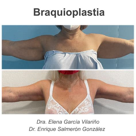 Braquioplastia En Instituto De Cirug A Pl Stica Del Mediterr Neo