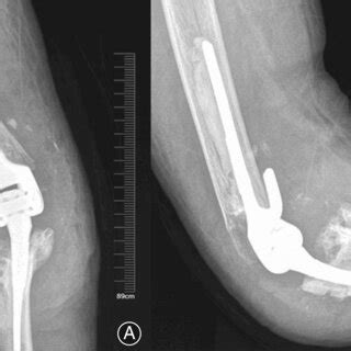 The X‐ray of elbow joint of case 1 at 6 months after operation, showing... | Download Scientific ...