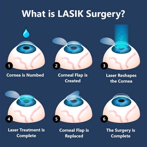 Lasik Eye Surgery Cost 2025 Simon Wilkins