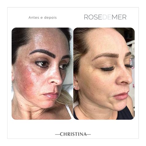 Peeling Rose De Mer Para Melasma Christina Brasil