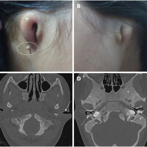 Pdf Diagnosis Of Osteopetrosis In Bilateral Congenital Aural Atresia