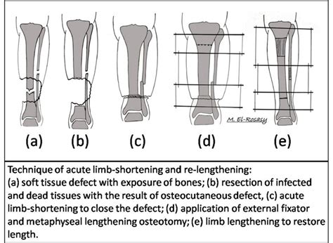 Diagrammatic Illustration Of The Technique Of Acute Limb Shortening And Download Scientific