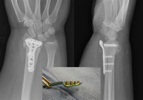 Failure Of Volar Locking Plate Fixation Of An Extraarticular Distal