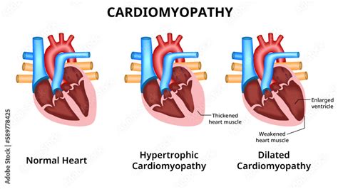 Types Of Heart Diseases Hypertrophic Cardiomyopathy And Dilated