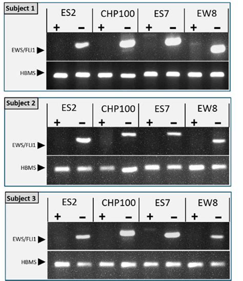 Detection Of The Es Specific Ews Fli Fusion Transcript In Purged