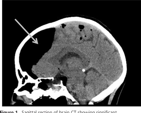 Figure From Symptomatic Pneumocephalus After Trans Sphenoidal Surgery